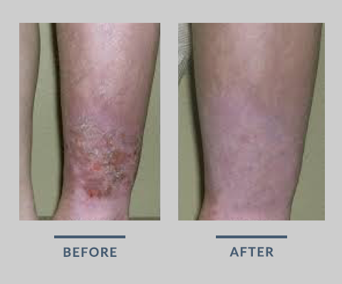 Before & After - Atlas Vein Care