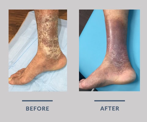 Before & after2 treating lower leg