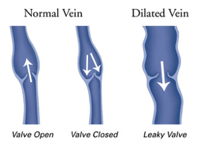 Vein Disease Treatment Arlington TX | Venous Reflux Arlington TX