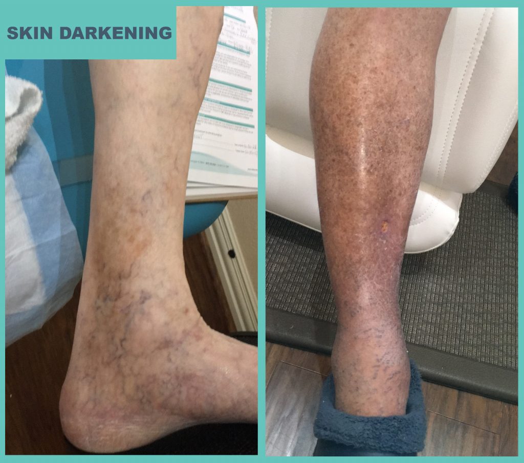 Skin Darkening-Atlas Vein Symptoms – Atlas Vein Care