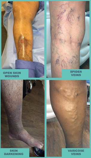 Symptoms of Vein Problems – Atlas Vein Care