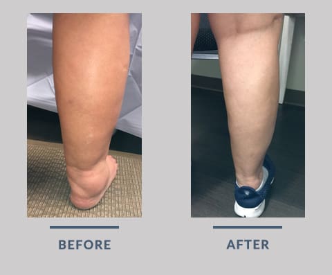 BeforeandAfter Leg Swelling Before and After