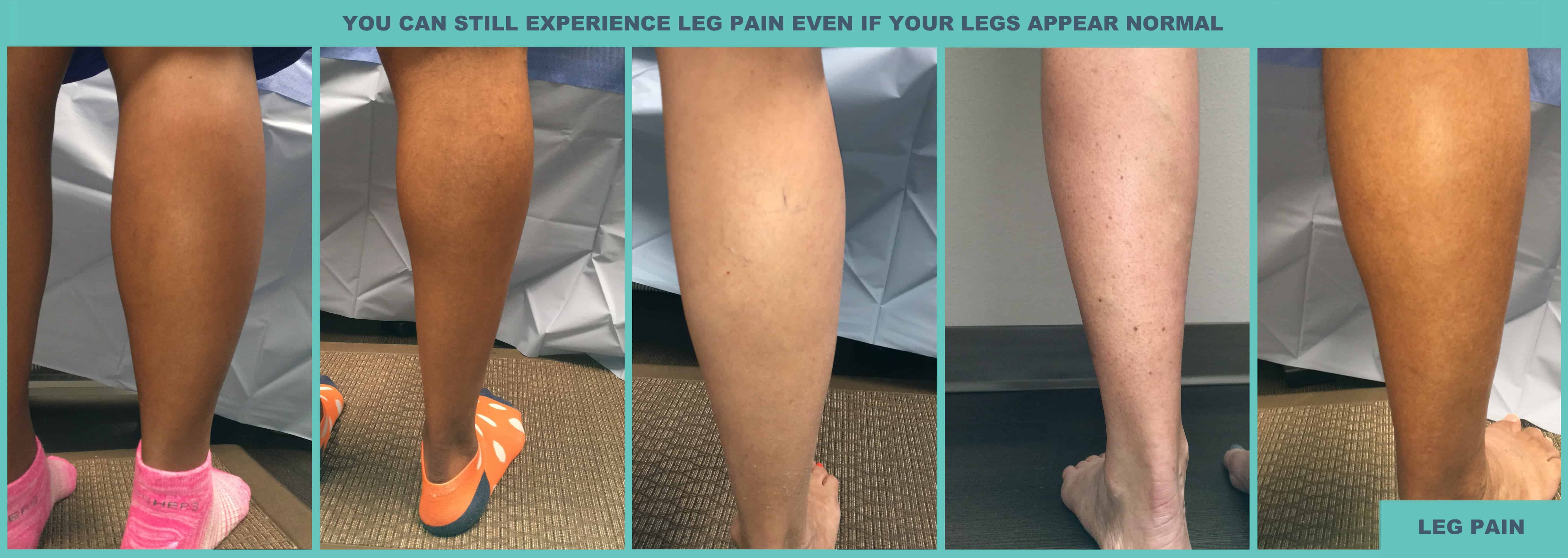 Atlas-Vein-Symptoms-Leg-Pain Atlas-Vein-Symptoms-Leg-Pain