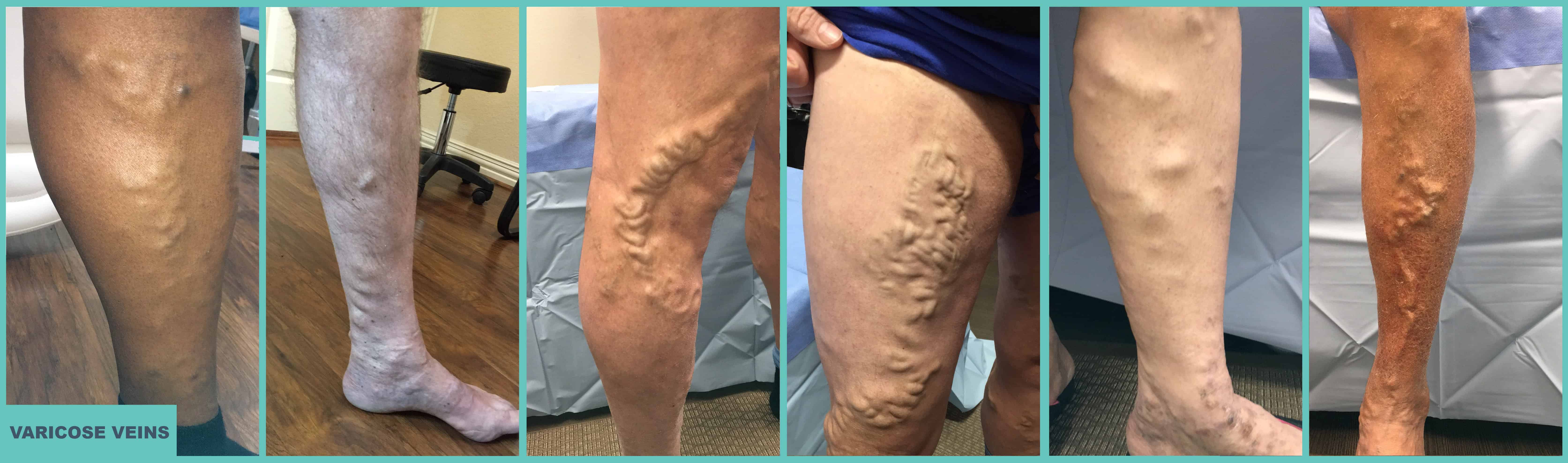 Atlas-Vein-Symptoms-Varicose-Veins Atlas-Vein-Symptoms-Varicose-Veins