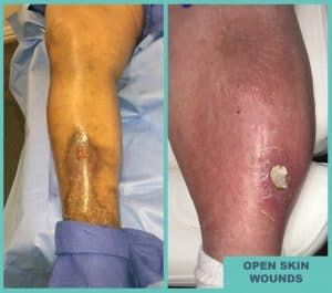 Open-Sore-Wounds-Atlas-Vein Open-Sore-Wounds-Atlas-Vein