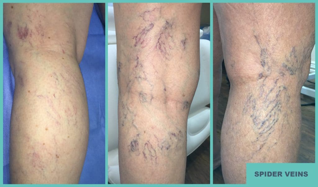Spider-Veins Spider-Veins