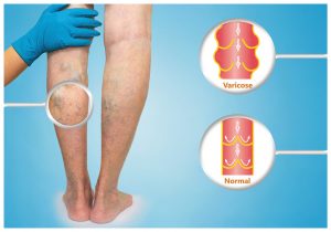 Vein Disease Symptoms Arlington TX