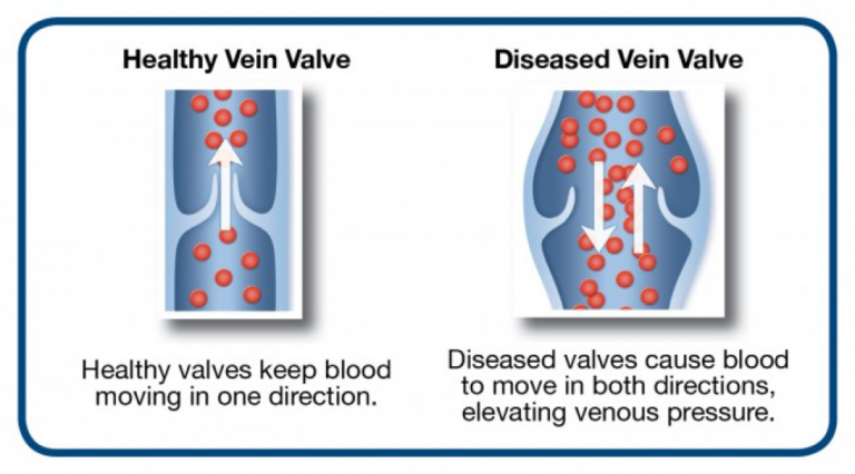 What are Vein Problems? | Atlas Vein Care