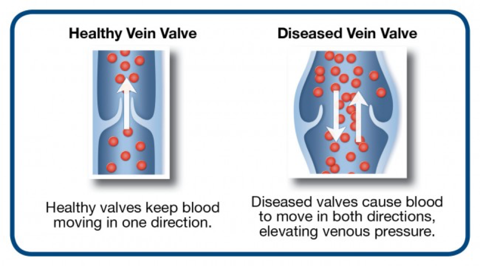 venous-reflux