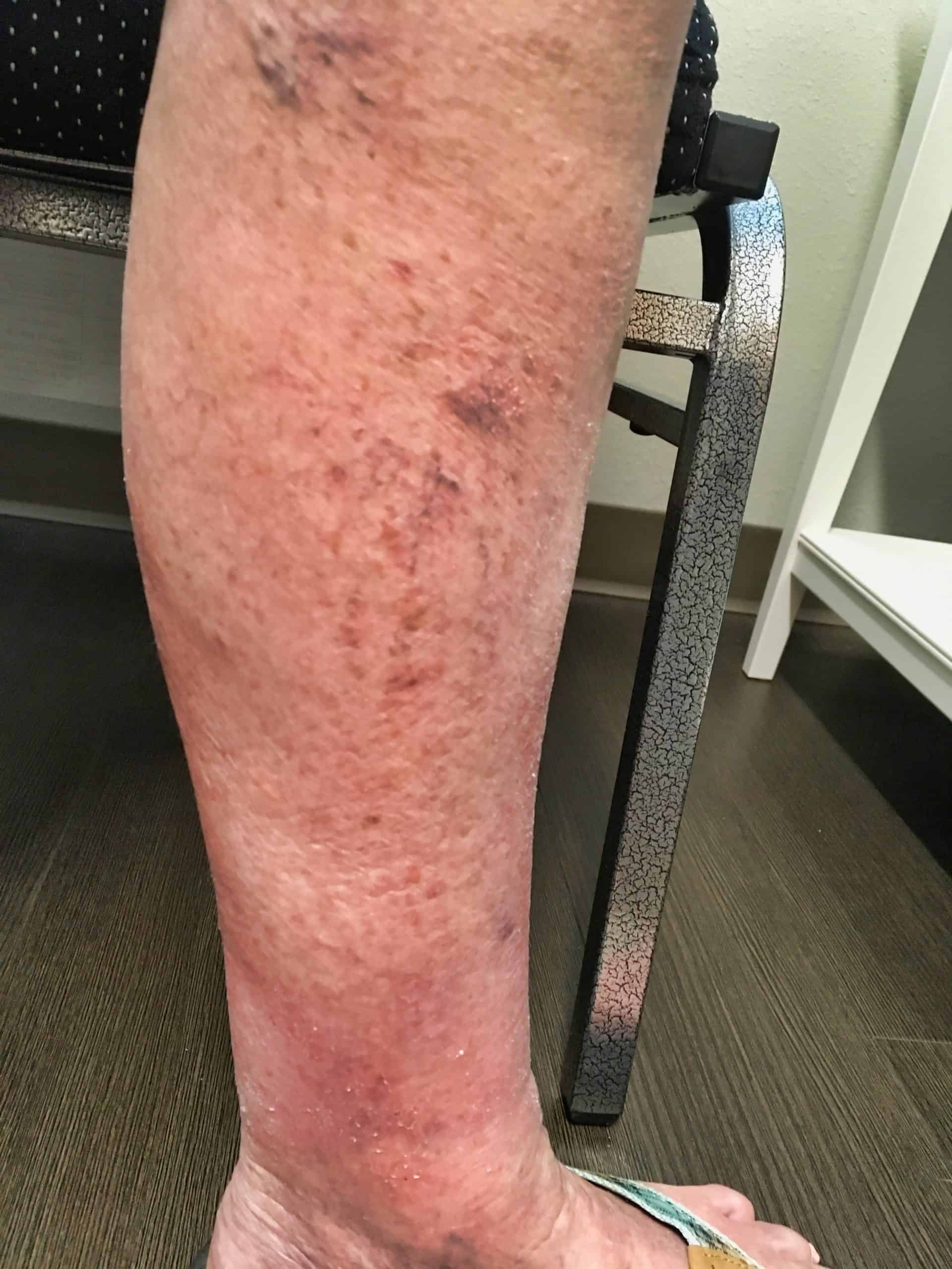 The Connection Between Vein Damage and Leg Swelling