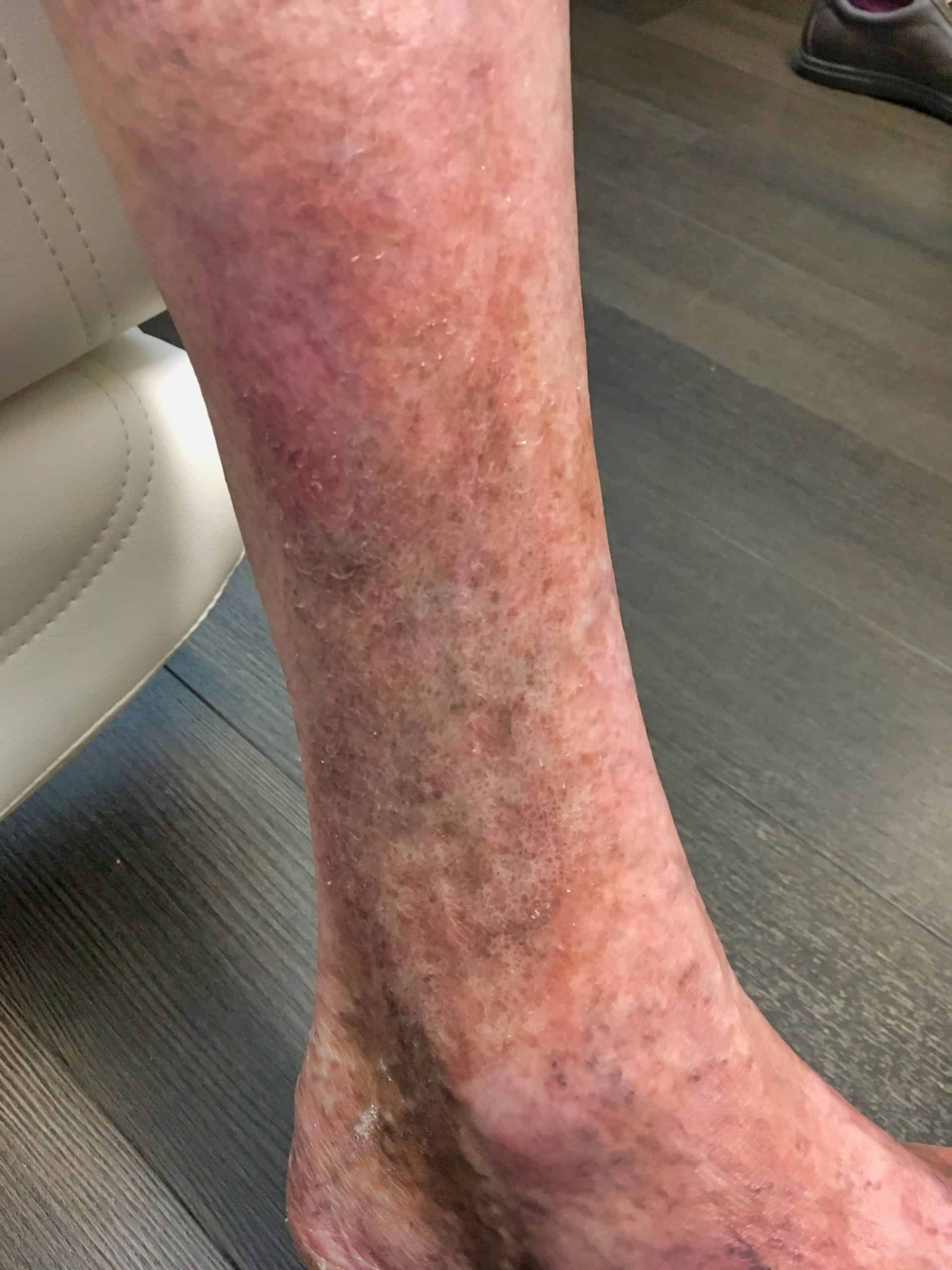 Vascular Issues Feet