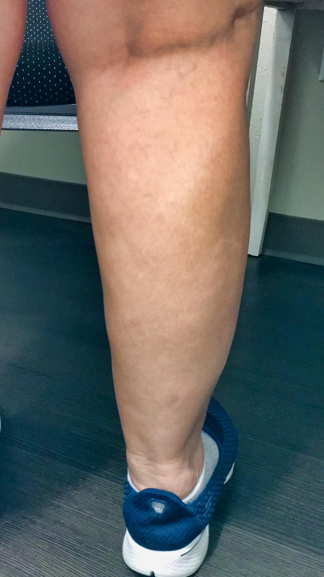 Swelling after 4 and a half months Swelling after 4 and a half months