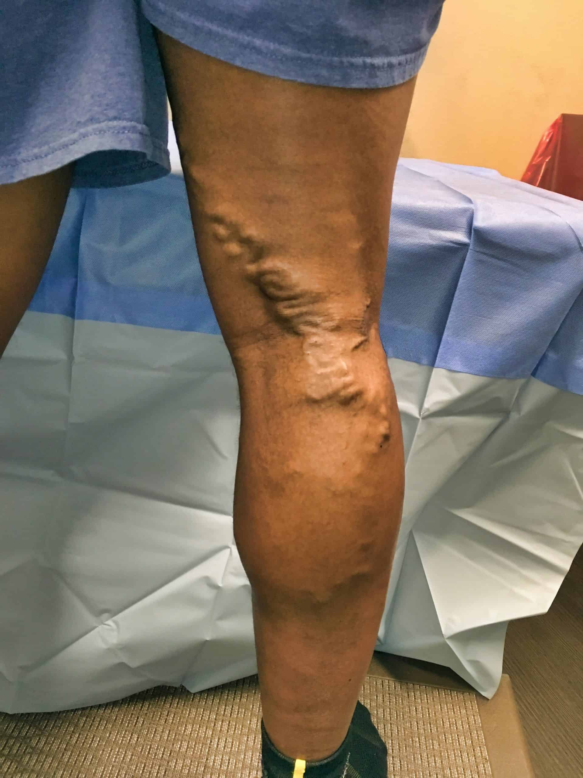 Varicose veins – more than a cosmetic concern