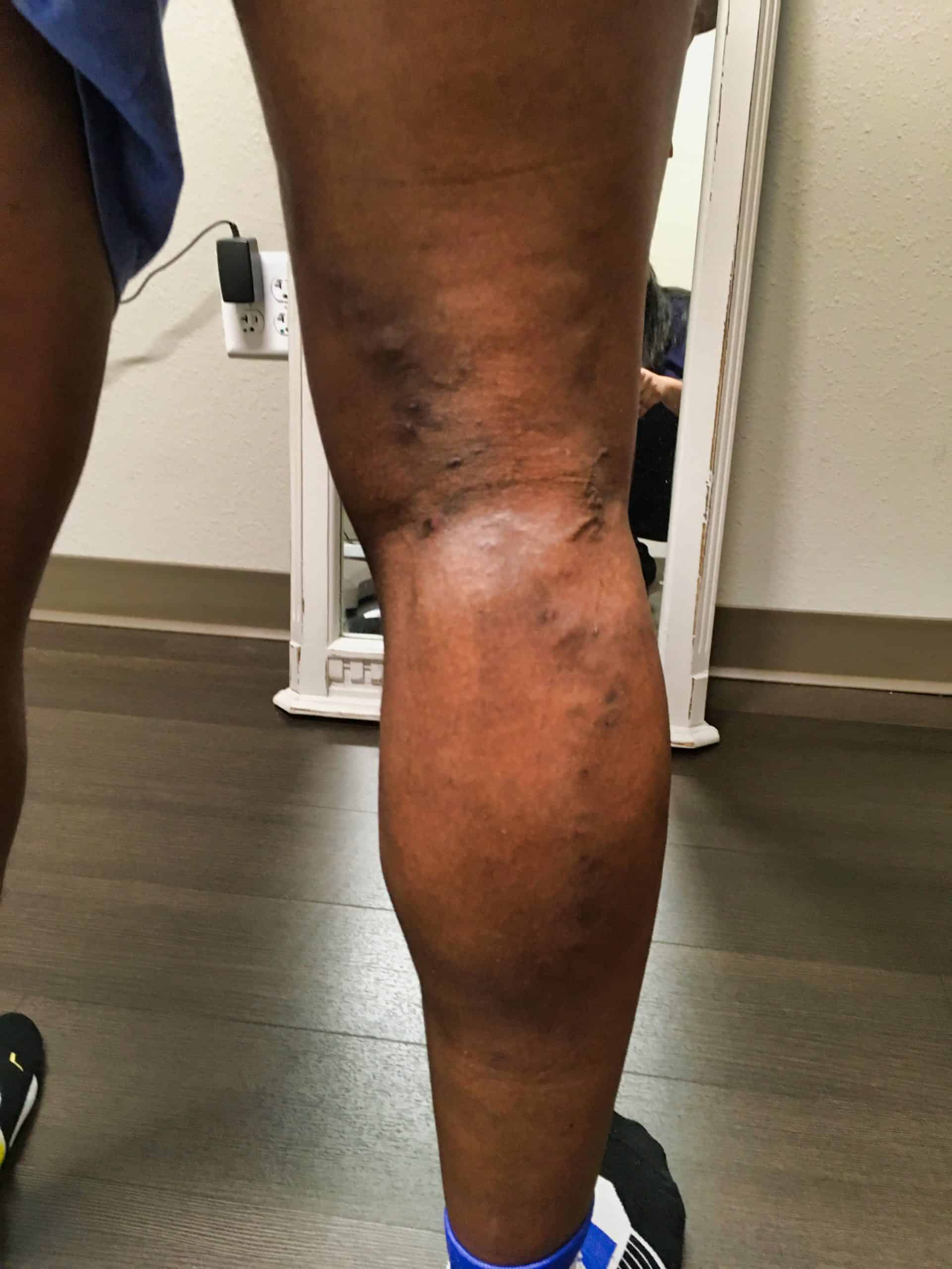 Vericose Veins after 5 weeks of treatment