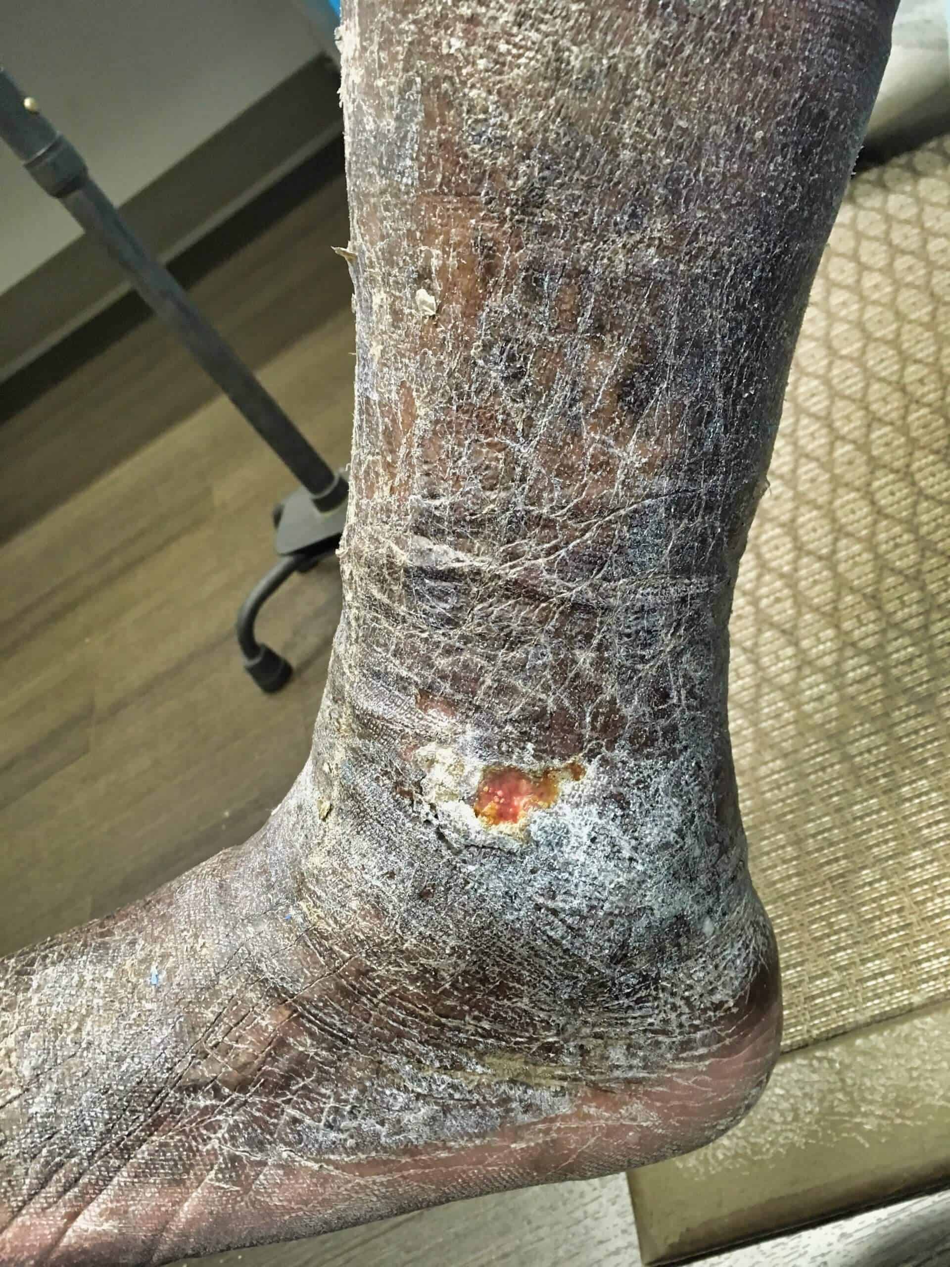 A "before photo" of a leg suffering from ulcers before treatment