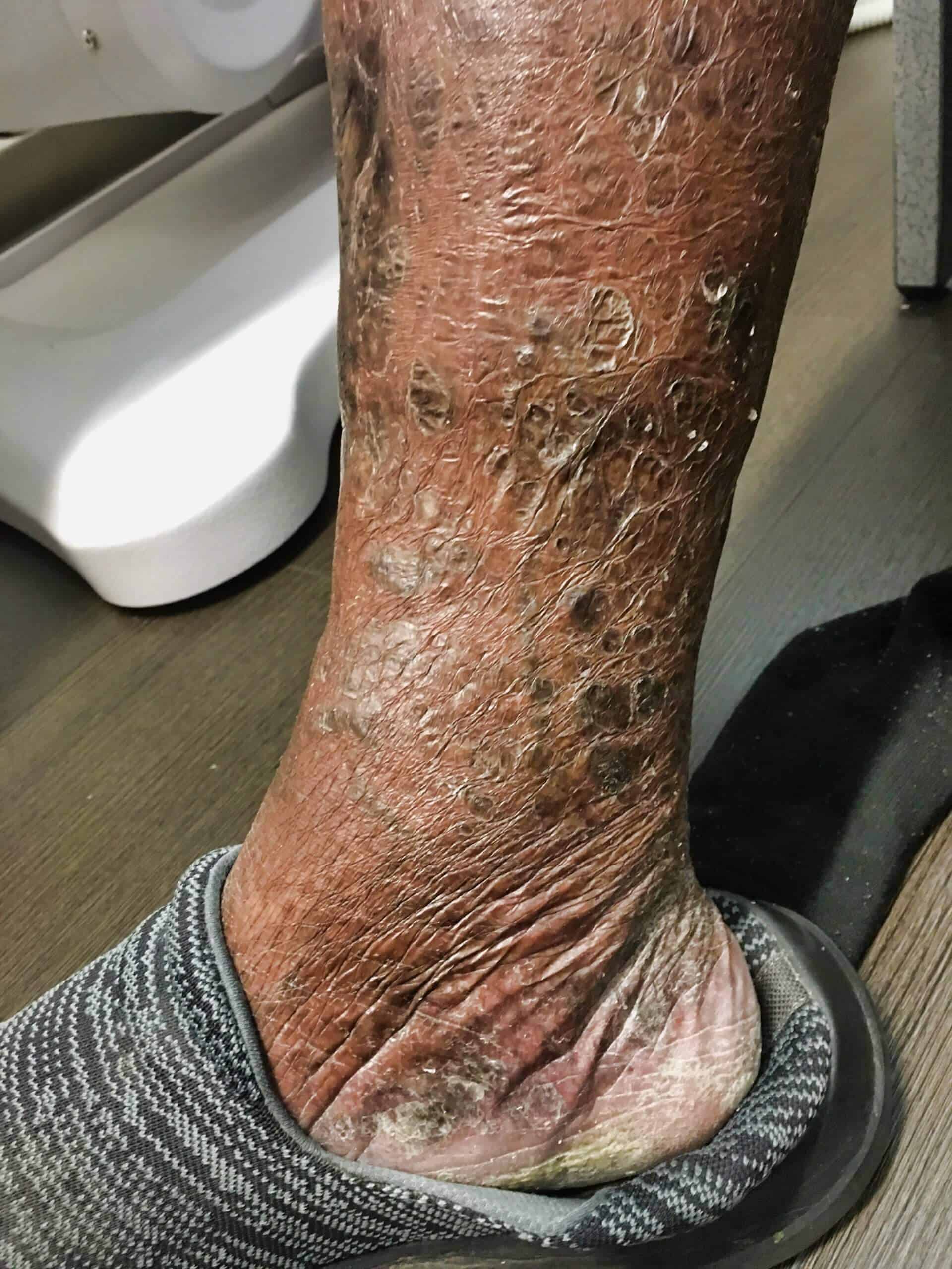 a progress photo showing reduction in ankle and skin ulcers three hours after treatment