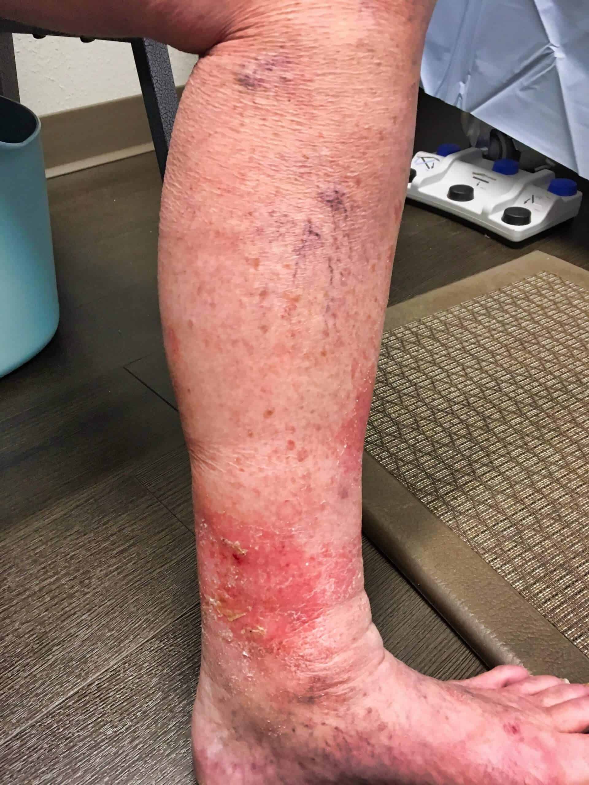 Discoloration-and-inflammation-before-scaled