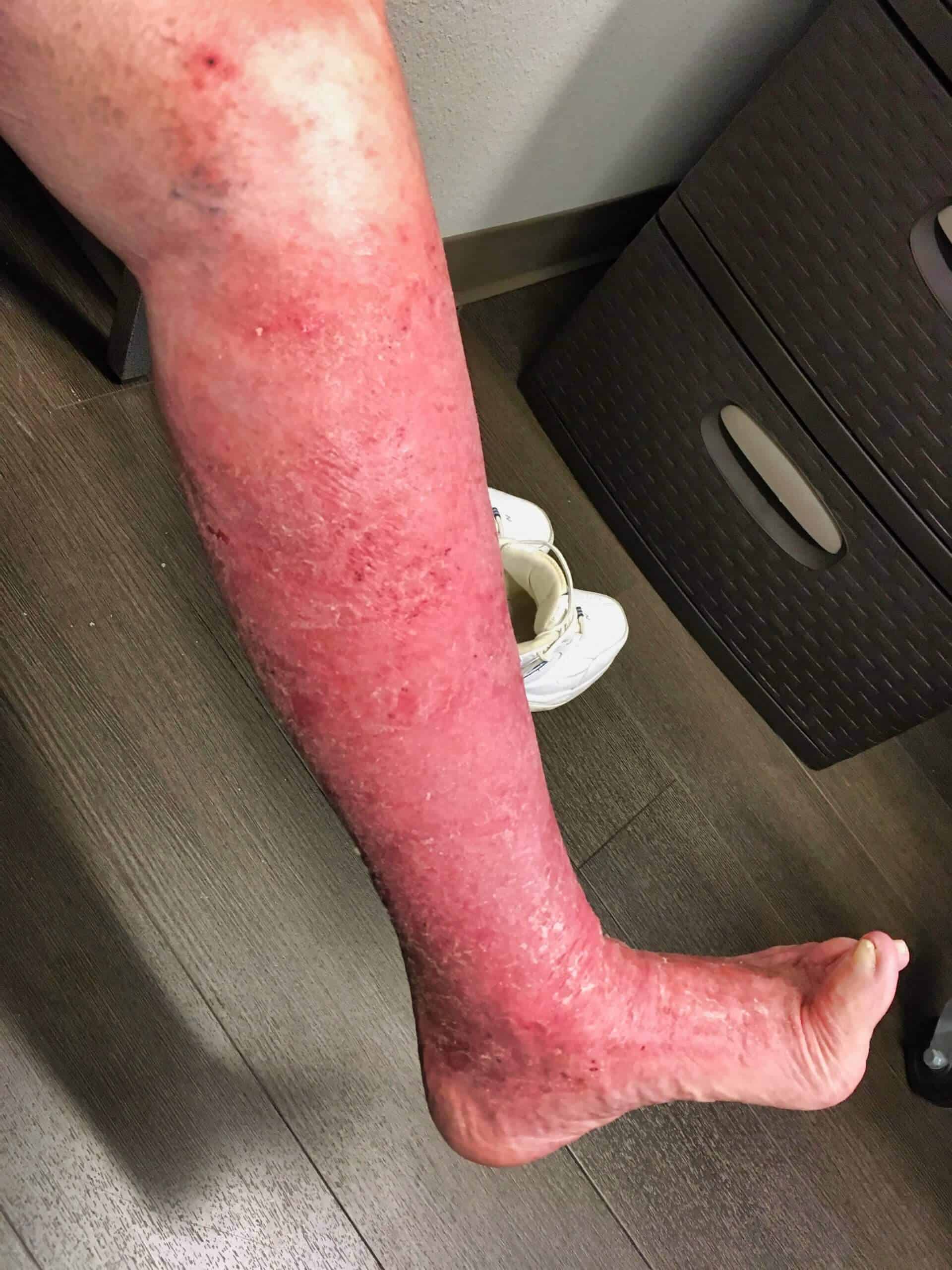 A photo of a very red leg before treatment