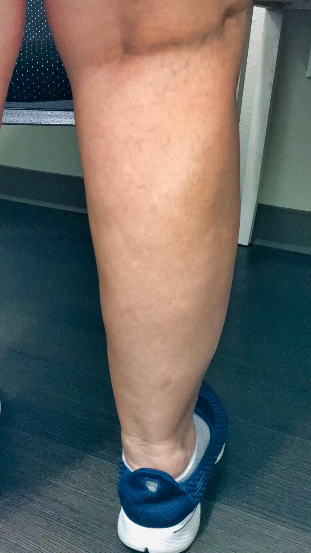 A photo showing a reduction in swelling after four and a half months of treatment