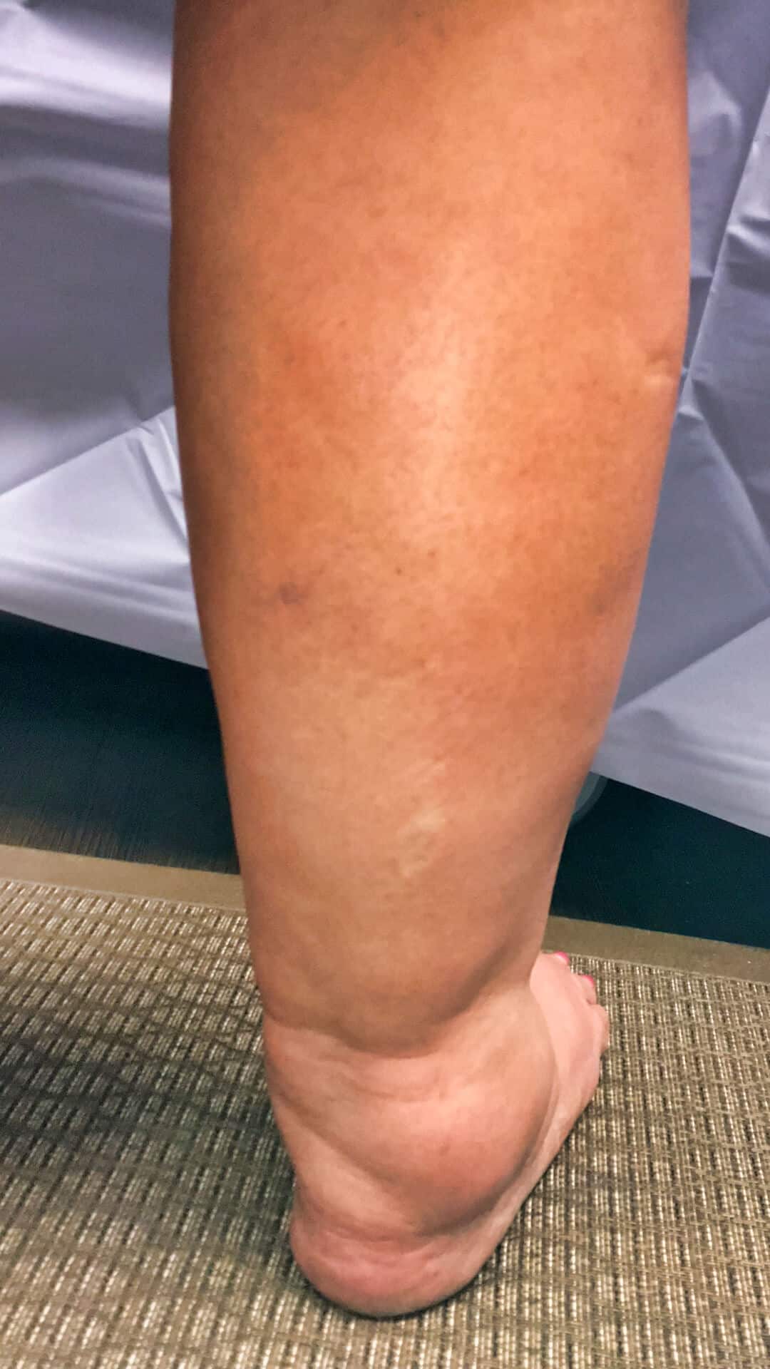 Lower Leg Discoloration: What Does It Mean?