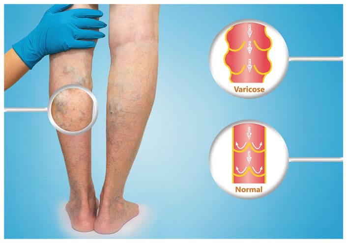 varicose veins treatment