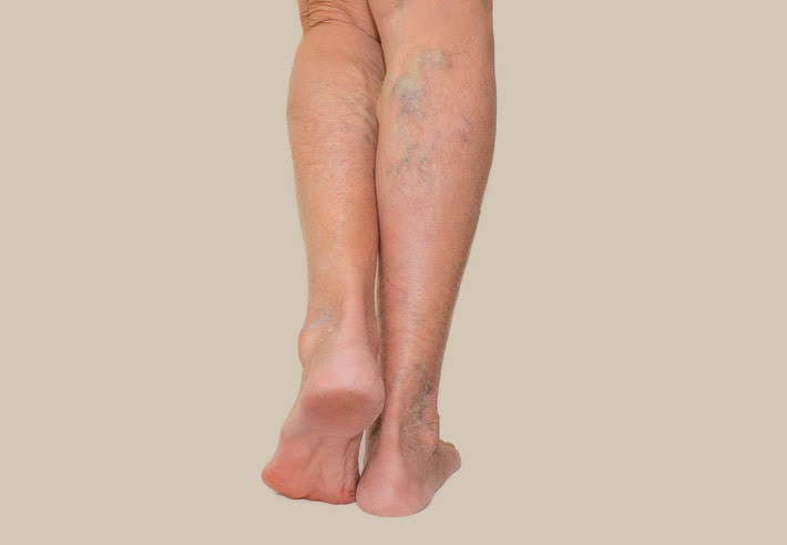 varicose veins