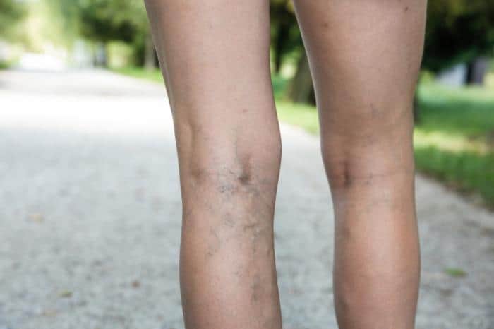 varicose veins