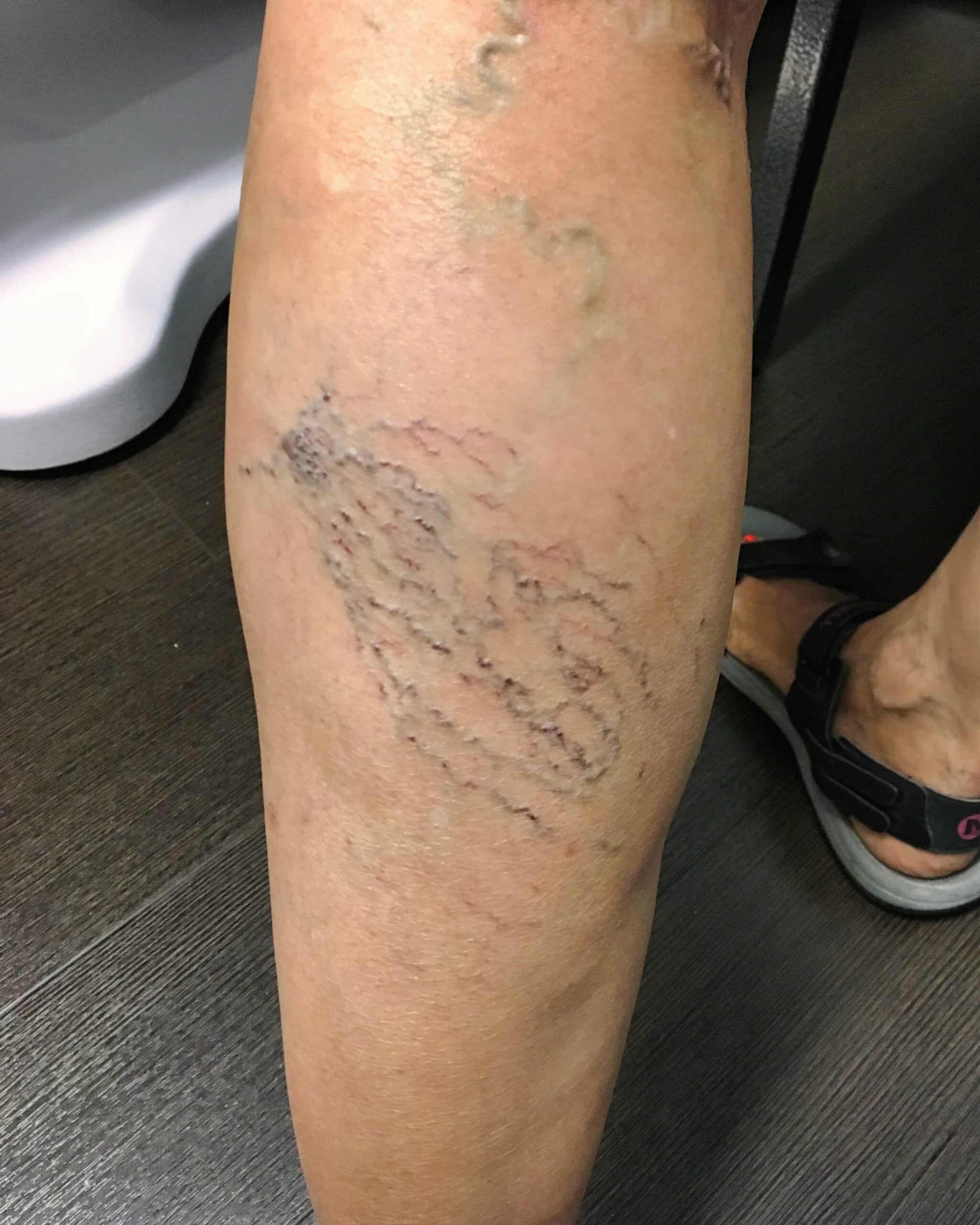 CReyes Before Spider Veins