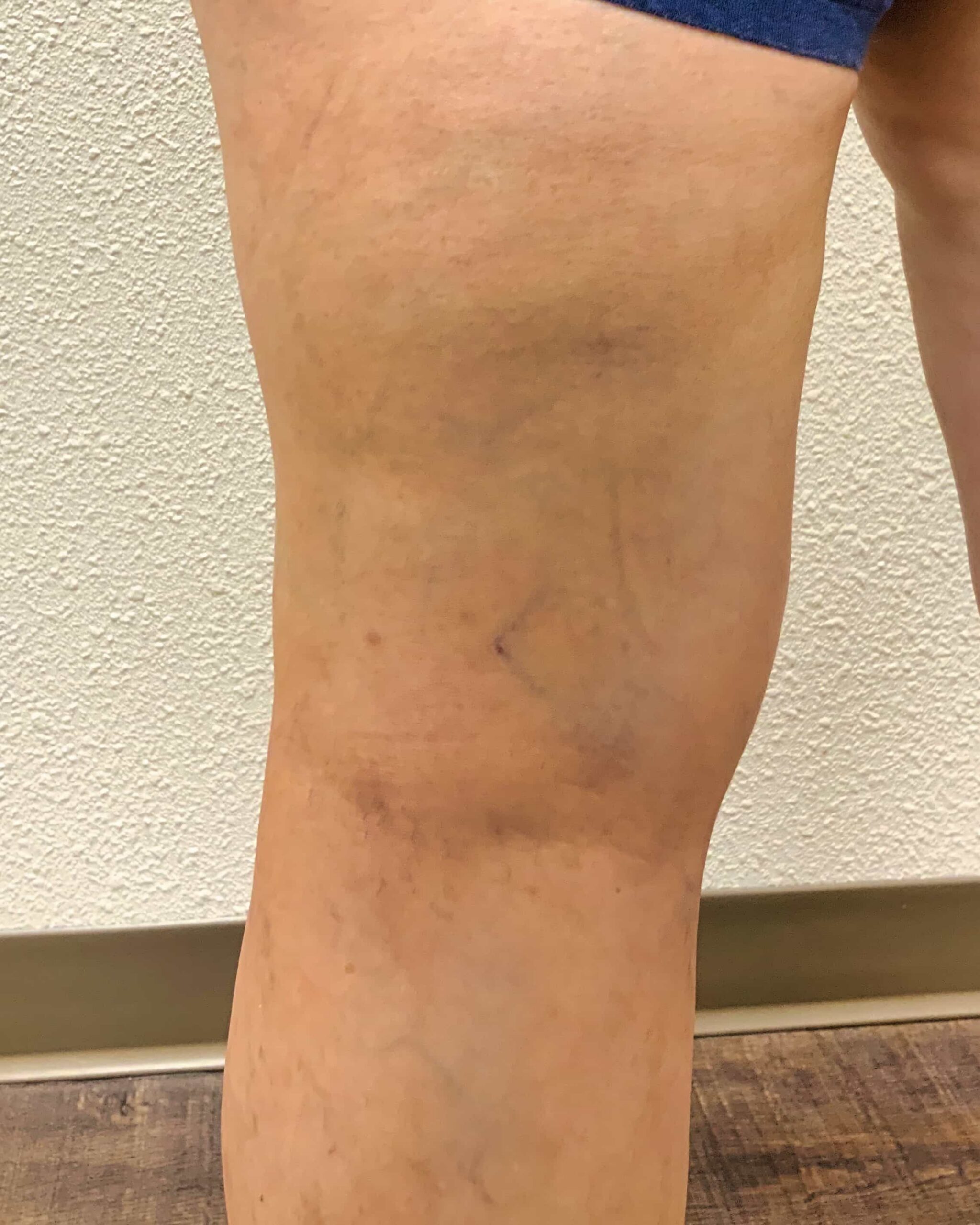 KCaraway1 After Spider Veins