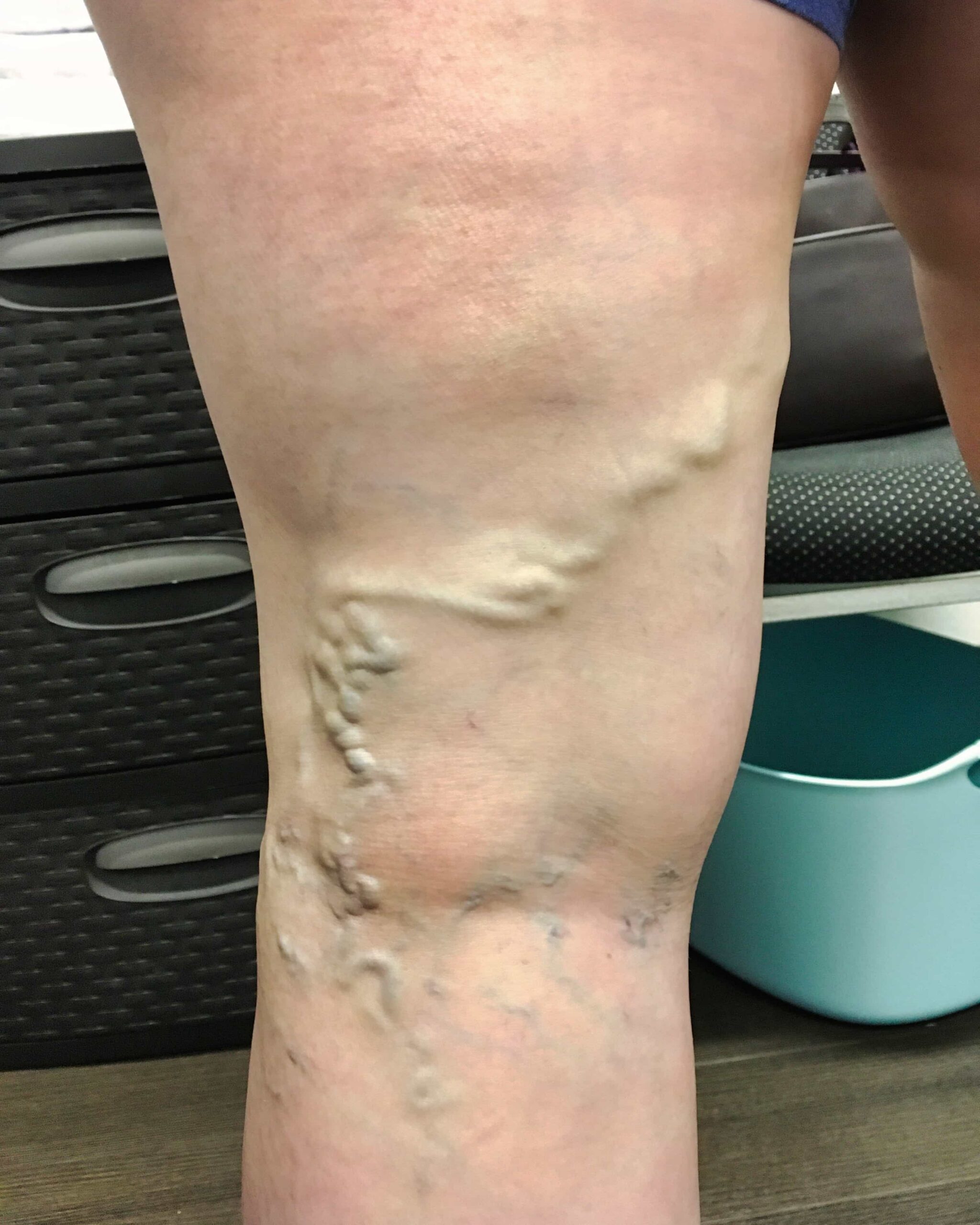 KCaraway1 Before Spider Veins